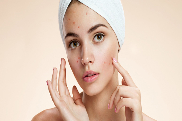 Skin Care Tips:कील मुंहासे को दूर करेगा यह तरीका, बदल दीजिए अपनी आदत