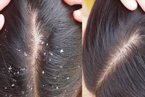 Hair Care Tips: डेंड्रफ की परेशानी से इस तरह पाएं छुटकारा, डैमेज नहीं होंगे बाल